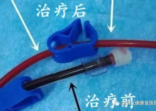 三氧自血療法可以治療什么疾??？